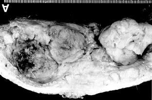 . 150 cm, 58 kg, 120 80 mmhg.. 2 cm 10.5 8 cm. 3 3 cm. (Fig 1).,. X-,. 4 cm,,... Fig. 2. Cross- section of the resected specimen.