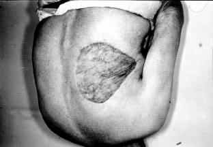 x40). B. The tumor is composed of spindle cells with storiform and/ or fascicular growth.