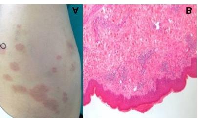 Herpes gestationis associated with normal pregnancy or complete hydatiform mole: report of three cases Figure 1, Case 1 - A) Erythematous-to-hyperpigmented plaques of the thighs.