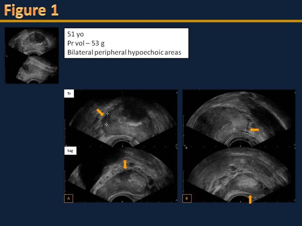 Images for this section: Fig. 1: Sagittal and transverse TRUS of the prostate. A - hypoechoic nodule in the anterior horn of the peripheral right midgland (arrow).