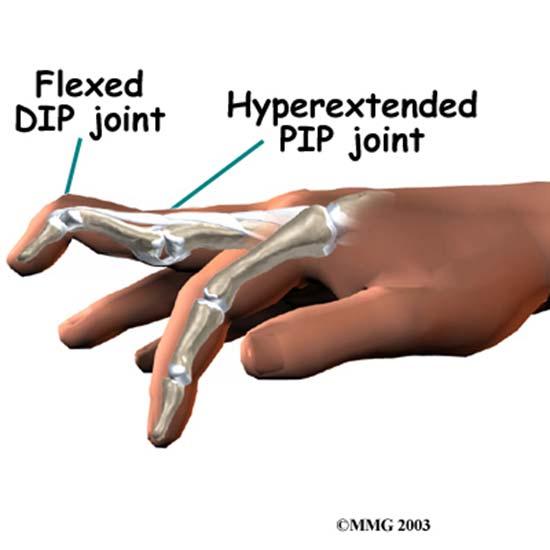 Spring 2014 EXSC 201 01 15 Swan Neck Deformity a deformity where there is fixed flexion at the DIP & hyperextension at the PIP may be a complication of a poorly