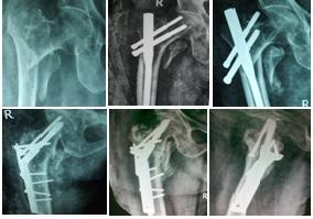 5 cm shortening OBSERVATION & ANALYSIS Thirty patients with an unstable comminuted intertrochanteric femoral fracture (AO/OTA type 31-A2.2, A2.3, A3.
