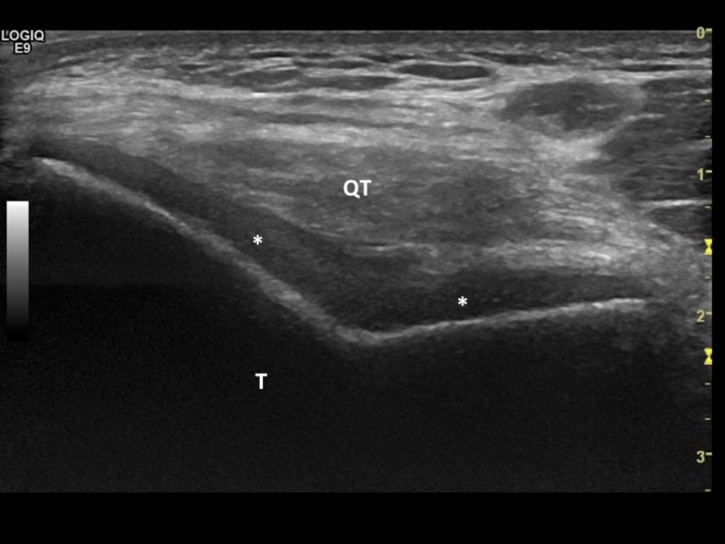 Fig. 5: *: Articular cartilage of the trochlea;