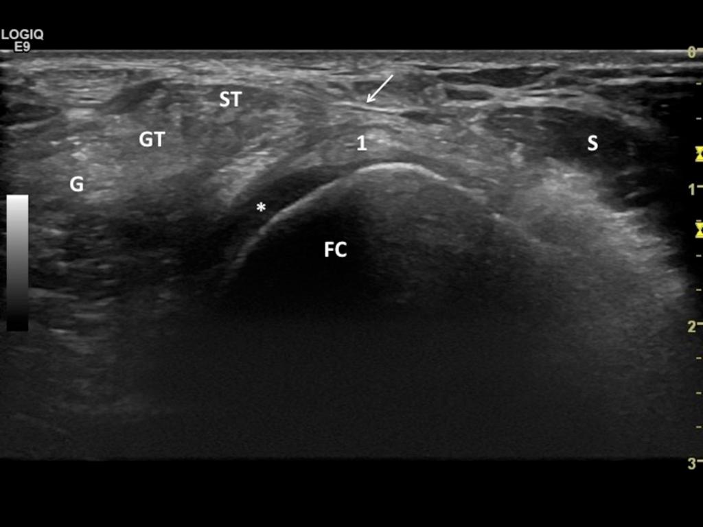 Fig. 18: *: Articular cartilage of the medial femoral condyle; ST: Semitendinosus tendon; Arrow: Saphenous nerve; FC: Medial femoral