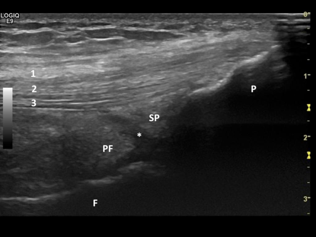 Fig. 2: 1: Superficial layer (from rectus femoris); 2: Intermediate layer (from vastus lateralis and vastus medialis); 3: Deep layer (from