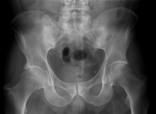 Bilateral Grade 3 Radiographic Sacroiliitis: Bony Changes Inflammation is not Visible on Plain X-ray Tips Symptoms Patient History Lab