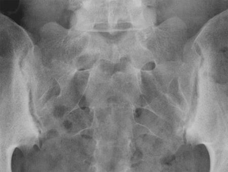 Bilateral Grade Radiographic Sacroiliitis: Bony