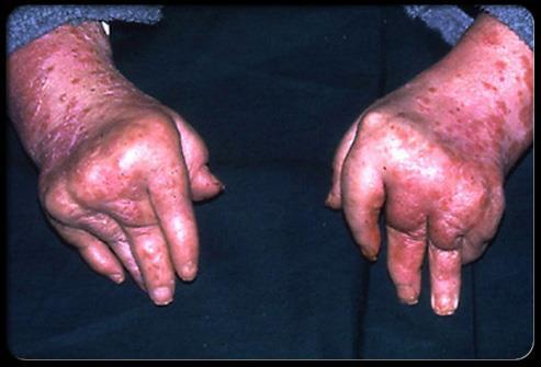 Arthritis Mutilans Tips Patterns Pathogene sis Morbidity Arthritis mutilans is a severe, deforming, and destructive form of psoriatic arthritis that primarily affects the