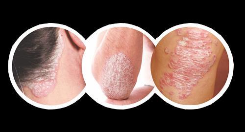 Actively inflamed joints Subclinical 97% of patients affected Clinical Imaging Criteria Plaque psoriasis 94% of patients affected scaly