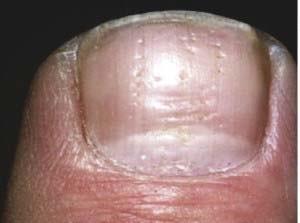 Subclinical Nails Clinical Imaging Criteria 83% of patients affected Fingernail