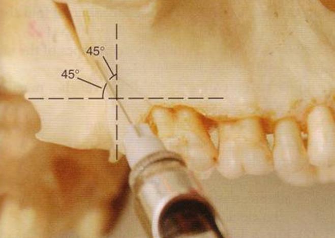 MAXILLARY INJECTION TECHNIQUES Posterior Superior Alveolar Nerve Block