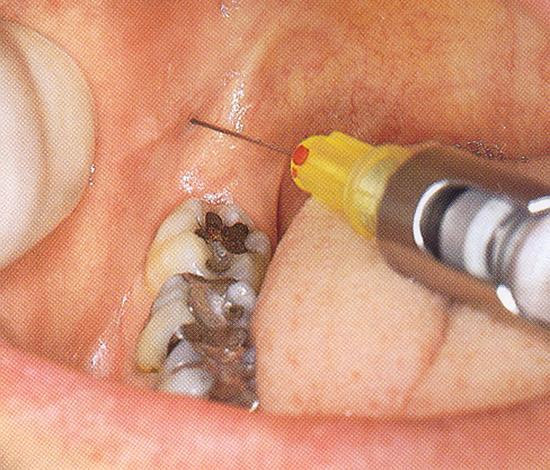 mandibular ramus Place barrel of syringe in the corner of the mouth on the