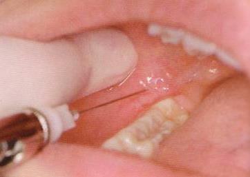 distal and buccal to the terminal tooth Advance needle