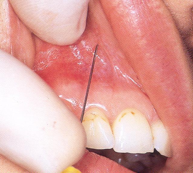 MAXILLARY INJECTION TECHNIQUES Supraperiosteal Injection (Local Infiltration) 25-gauge short needle Syringe