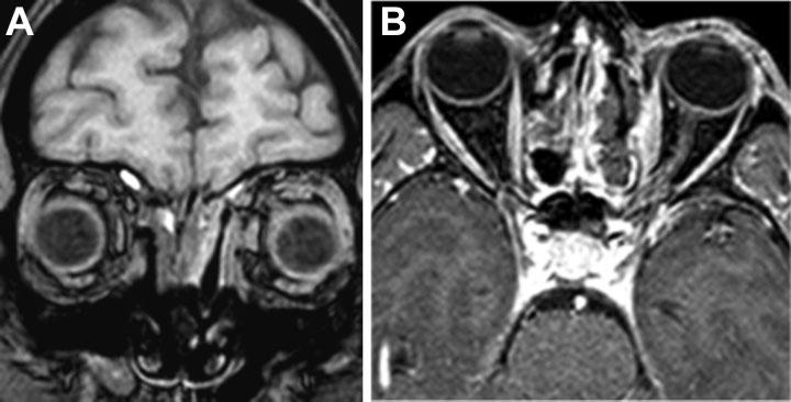 e108 Management of a Selected Superomedial IOL Castelnuovo et al. Fig. 3 Postoperative magnetic resonance imaging (MRI) scan showing no residual disease. (A) Coronalview.(B) Axialview. nerve.
