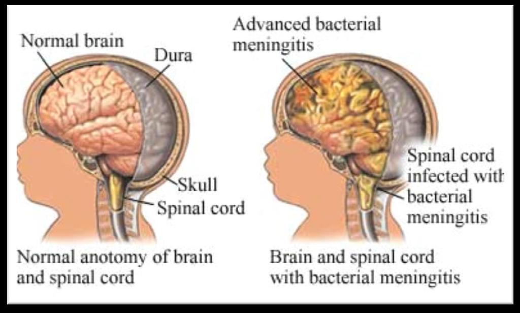 Swelling of the lining around the brain and spinal cord, also known as