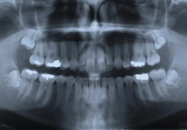 thickness and length, and upper incisors in normal vertical and anteroposterior position, but