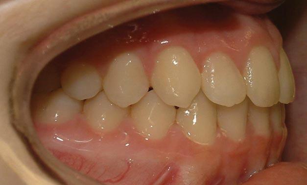 extractions, along with advancement of lower incisors and some interproximal reduction in lower