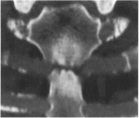 Coronal 2-D reconstruction showing slight joint space narrowing, subchondral sclerosis and cyst formation, and osteophyte formation at the inferior margin of the clavicle. Fig. 2. Arthritis of the manubriosternal joint in a 22-year-old man with pain and swelling for 5 months.