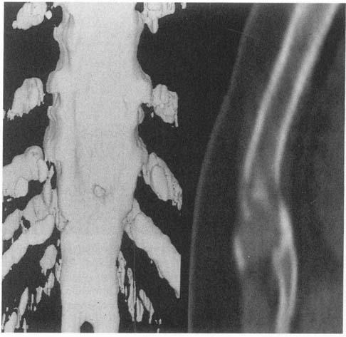 Sequelae of clavicular fracture in a 43-year-old woman involved in a traffic accident 2 years earlier.