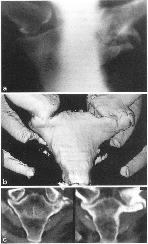 ANTERIOR CHEST WALL JOINT AND BONE DISORDERS BY SPIRAL CT 47 1 Fig. 6.