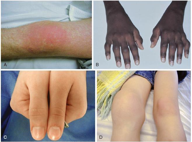 Juvenile idiopathic arthritis (JIA). A, Erythema of the knee in a patient with systemic-onset JIA (Still disease).