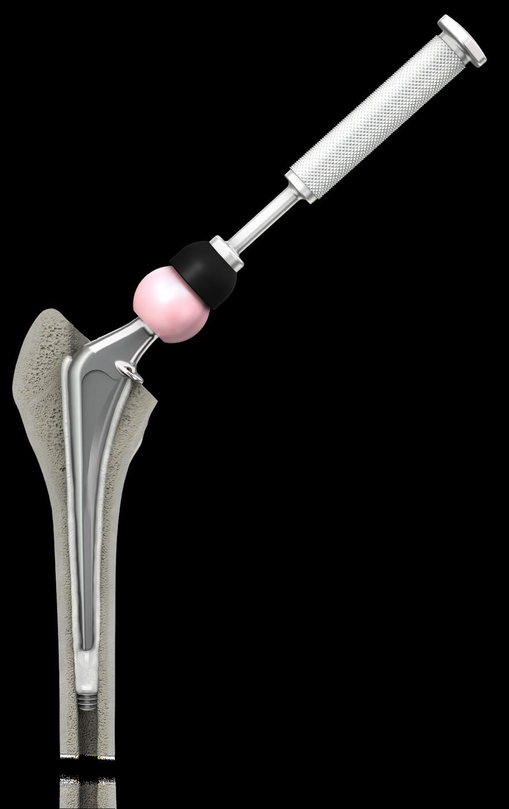 Figure 12: Femoral Implant Insertion Figure 13: Femoral Head Impaction 10. Femoral Component Insertion The Broach was designed to provide a minimum cement mantle of 2 3mm circumferentially.