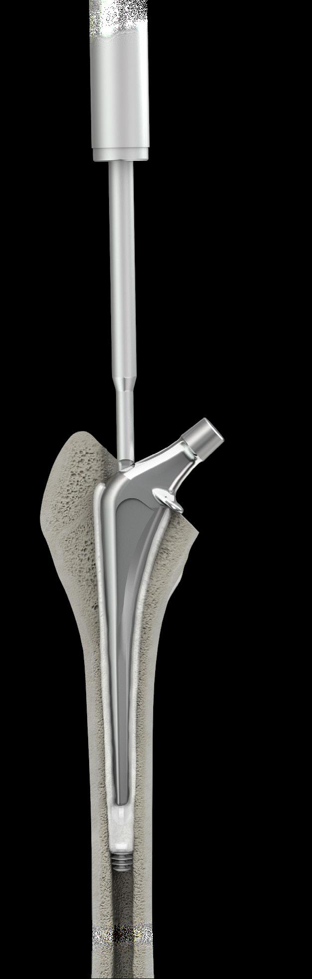 Use the Stem Inserter to slowly advance the Implant into the cement column, while keeping the proximal femoral opening partially occluded with your thumb.