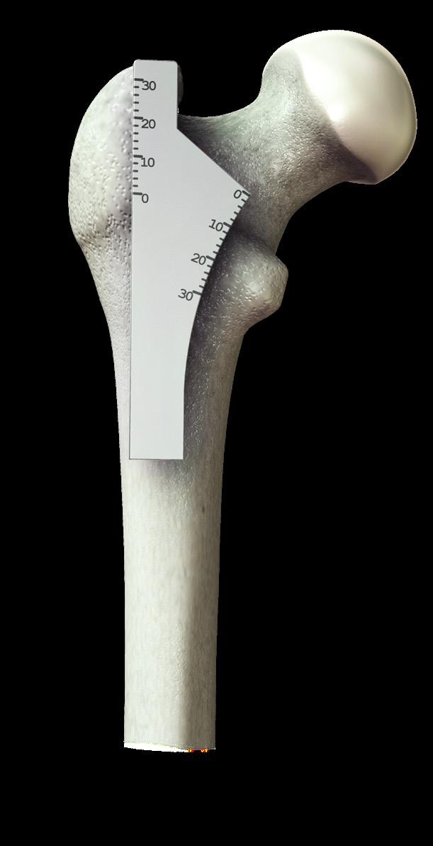 Femoral Neck Resection The Neck Resection Guide may be used to mark the desired neck resection level and angle (Figure 1). This may also be confirmed by using the templated resection level.
