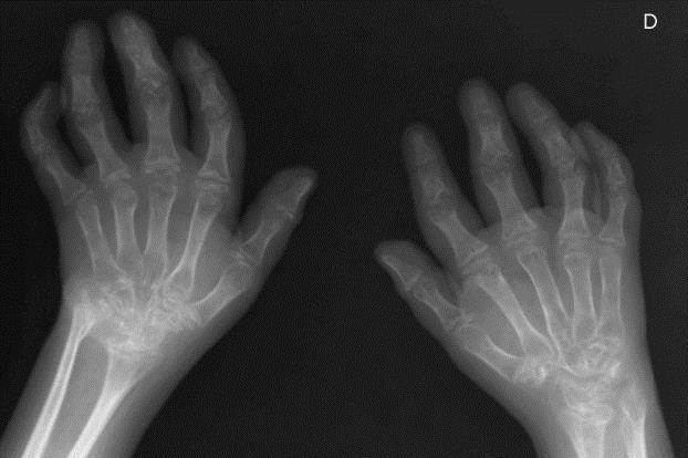 Radiograph of the hands reveals joint space narrowing and