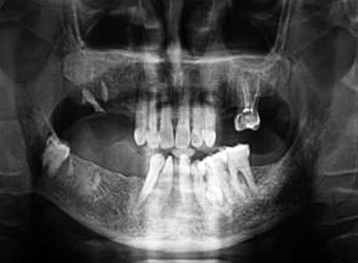 The teeth 32 and 42 were rotated and there was no space for the replacement of missing 31 and 41. The lower anterior teeth showed recession with bone loss and lingual tissue undercuts.