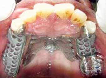 The tooth 26 was prepared, and a mesial rest seat was incorporated in the wax pattern, the crown was fabricated and cemented with zinc phosphate cement (Fig. 7).