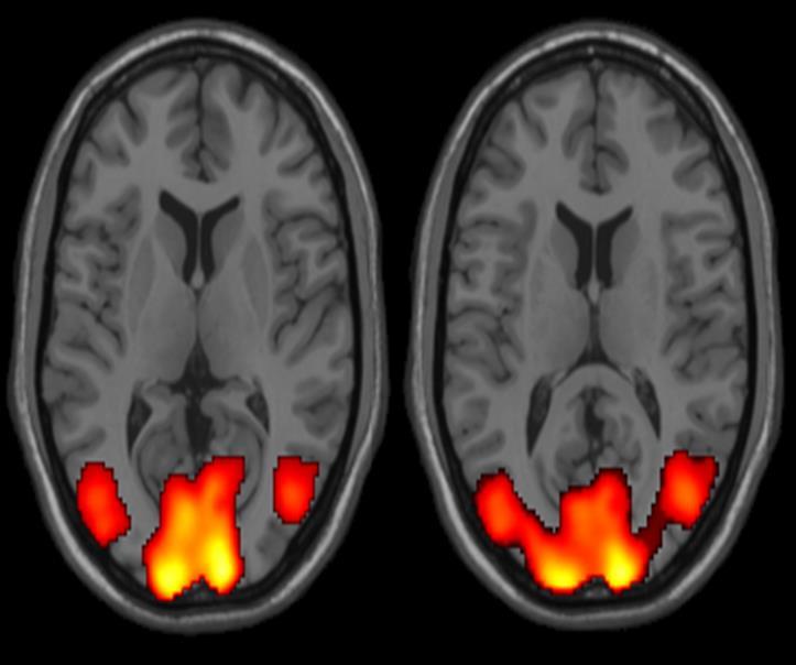 IMAGING True concussion has no imaging findings Acute