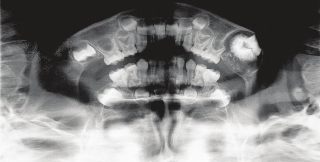 2 Case Reports in Dentistry Figure 1: Preoperative panoramic radiograph revealed a unilocular radiolucent lesion with scattered radiopaque foci in the center.