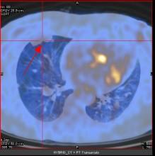 CA125 CA153 CA199 均正常水平 全身 PET-CT 提示 ( 图 2~):1) 肝右叶后段 左肾上腺 双肺 右胸膜 全身多处肌肉 骨骼多发高代谢占位, 考虑转移瘤 ;2) 网膜 肠系膜多发结节影, 代谢增高, 考虑种植 MT 进一步行肝占位穿刺活检, 病理 ( 图 3) 报告 : 镜下可见异型细胞, 肿瘤细胞呈梭形, 免疫组化