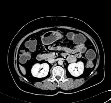 maximum 8 cm; Shows the right hepatic space-occupying lesion after 2 cycles of second-line systemic palliative chemotherapy by