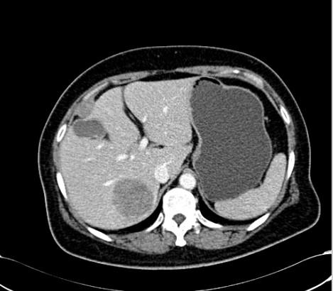 0 cm; Shows the right pleural lesion after 3 cycles of second-line systemic palliative chemotherapy by CT, and the maximum 2 cm;