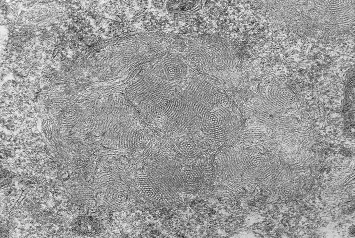 Making C. elegans models for Juvenile Neuronal Ceroid Lipofuscinosis Figure 1 Pure fingerprint body, typical of juvenile NCL (CLN3), X 75000.