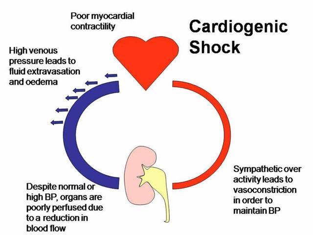 Cardiogenic Shock Cardiac failure reduction in CO due to impaired ability to pump (cardiac contractility) Cause AMI (manifests when 40% or more of the left ventricle is ischaemic) Cardiac surgery