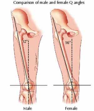 ACL Tear: Higher Incidence in Females Anatomic (Q Angle, Laxity, and Intercondylar Notch Size) Biomechanical (Landing Position)