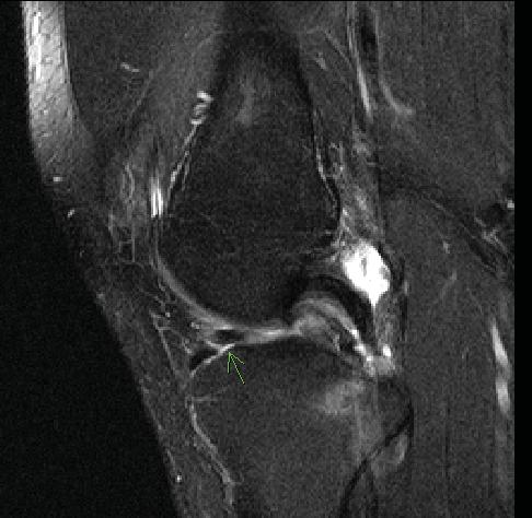 Risks of Delaying ACL Surgery?