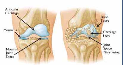 Osteoarthritis History Mechanism - Degenerative process - Develops slowly - Prior injury