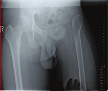 2 Case Reports in Orthopedics Figure 1: Radiograph of the hip joints at first visit. in cases involving a nearly complete resection of the half pelvis and the ipsilateral proximal femur. 2.