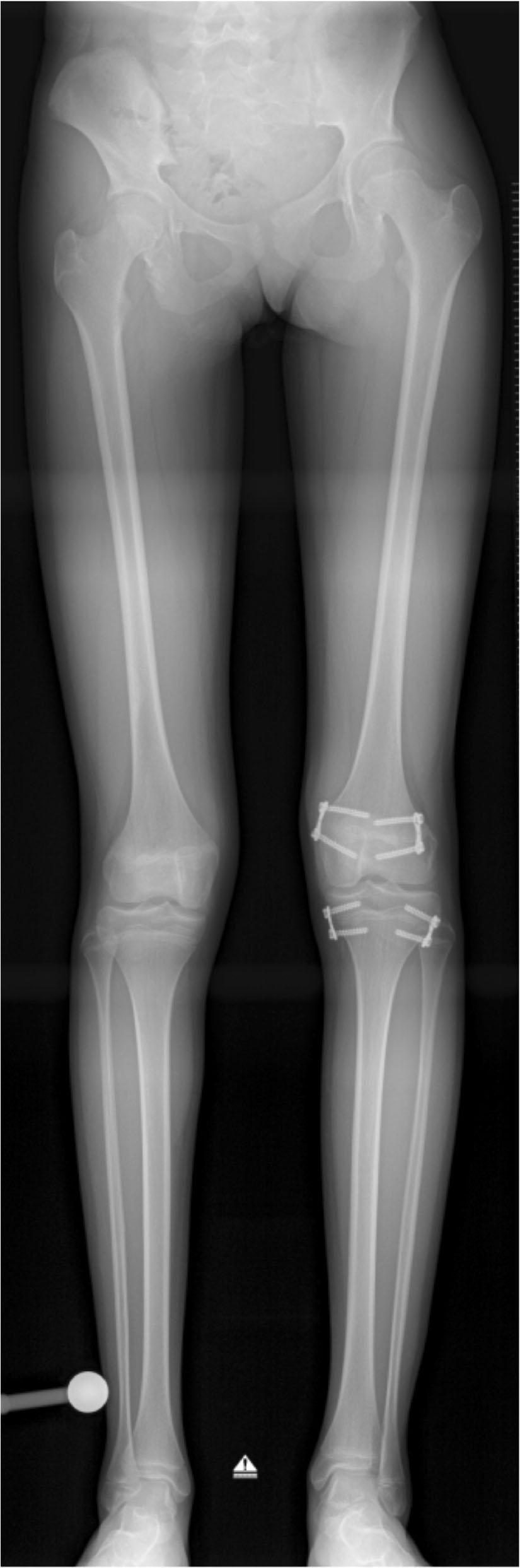 Borbas et al. Journal of Orthopaedic Surgery and Research (2019) 14:99 Page 3 of 7 Fig. 1 Long-standing X-ray of a patient with limb length discrepancy.