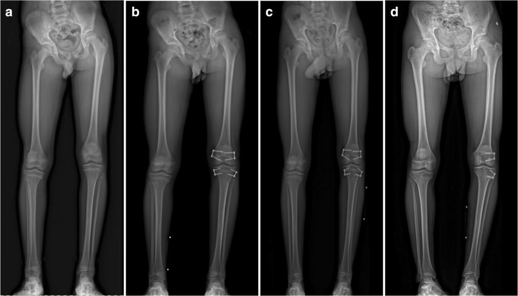 Borbas et al. Journal of Orthopaedic Surgery and Research (2019) 14:99 Page 6 of 7 Fig. 3 Case of a 14-year-old male patient with idiopathic limb length discrepancy.
