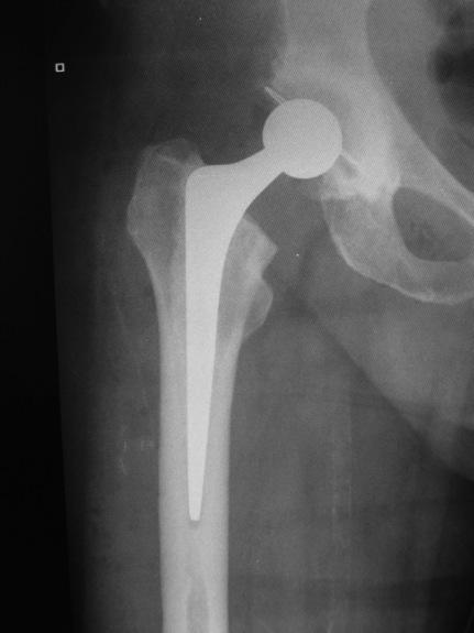 Fig. 2 An Exeter cemented hip arthroplasty How will a hip replacement help me? There are many potential improvements from a replacement hip. The main benefit is a reduction in your pain.