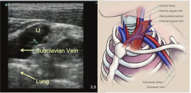At their juncture, there should be a large venous pool visualized on ultrasound (Image 16). An oblique probe orientation may be required to obtain the best imaging of this confluence.