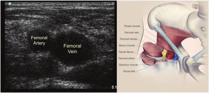 Page 3 of 13 Image 3: Ultrasound image of the right femoral artery and femoral vein with corresponding anatomic illustration.