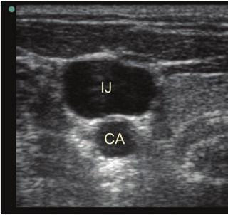 Page 7 of 13 Image 10: Ultrasound of the left internal jugular vein (IJ) directly overlying the carotid artery (CA).