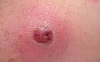 34. What type of skin lesion